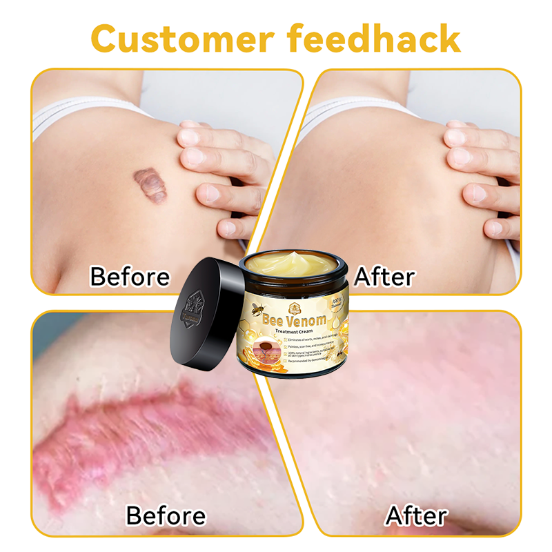 đđąđđđđąâą Bee Venom Skin Treatment CreamïŒEDQM đ
đđđđđđđđđđïŒ