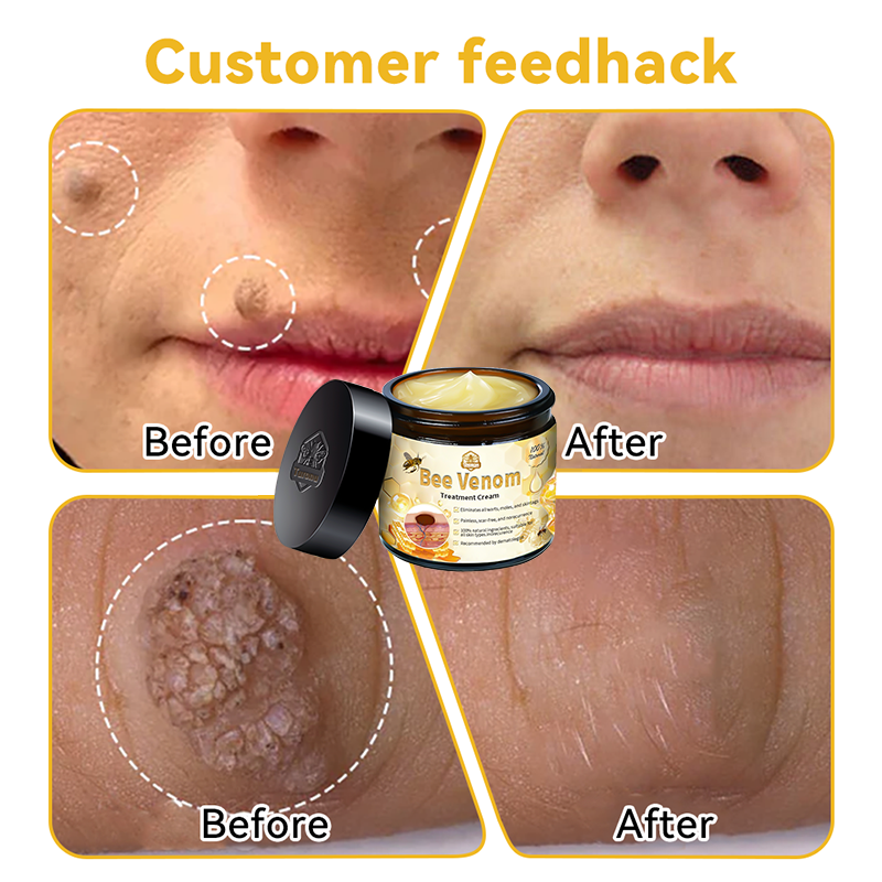 đđąđđđđąâą Bee Venom Skin Treatment CreamïŒEDQM đ
đđđđđđđđđđïŒ